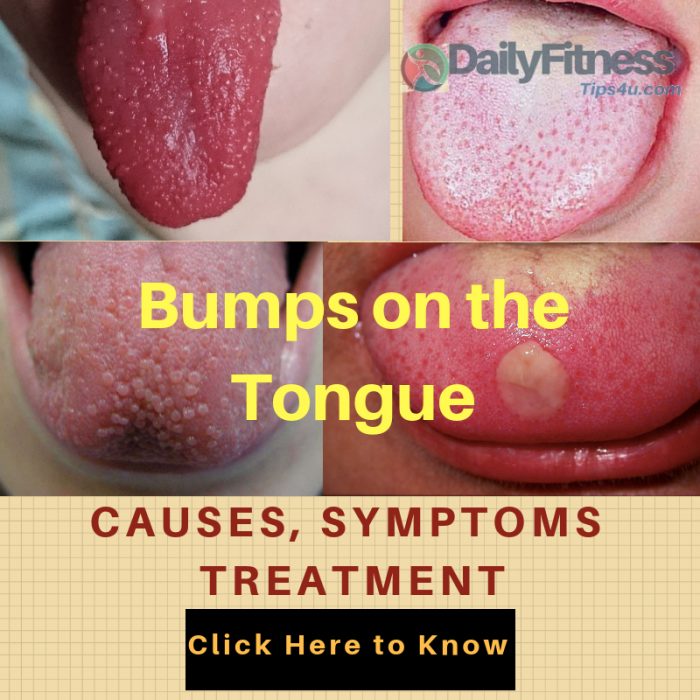 Bumps On The Tongue: Causes, Picture, Symptoms And Treatment